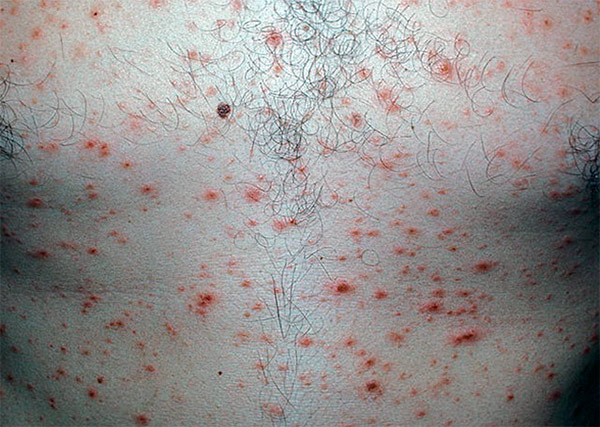 Парапсориаз: до сих пор не изученная болезнь кожных покровов
