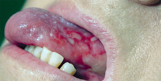 Красный плоский лишай в полости рта: настоящая проблема для пожилых людей