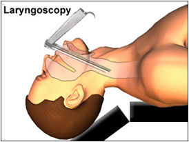 Ларингоскопия для удаления инородного тела