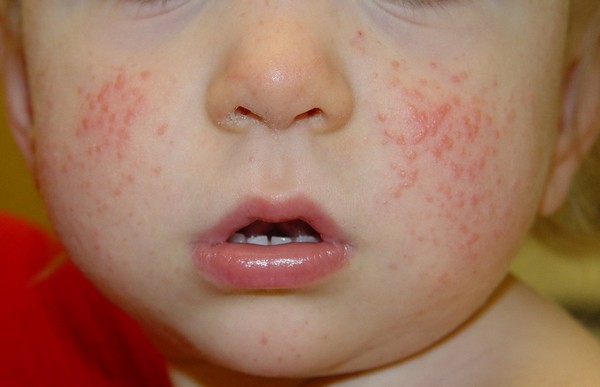 Атопический дерматит на лице у детей