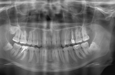 rentgenografiya-zubov