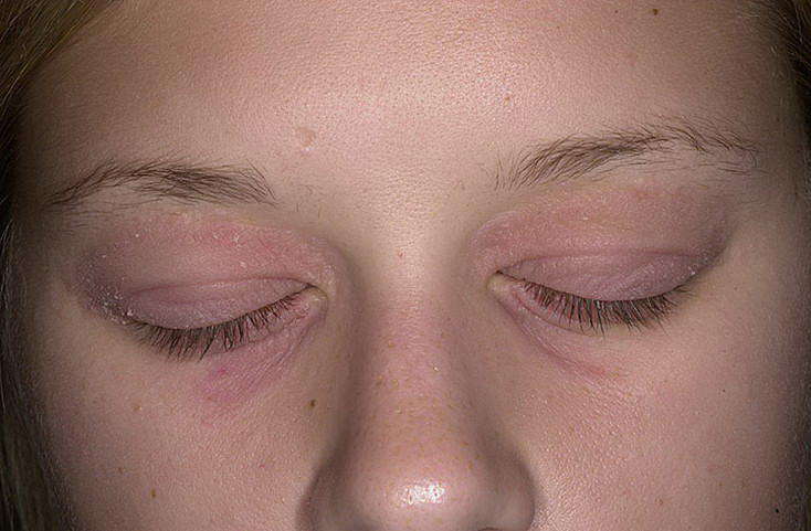 Аллергический дерматит вокруг глаз