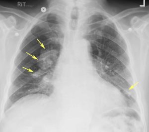Рентгеновский снимок легких при пневмокониозе