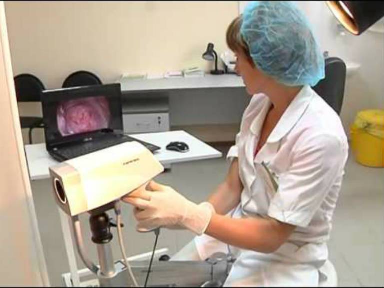 Лечение эрозии шейки матки радиоволновым методом