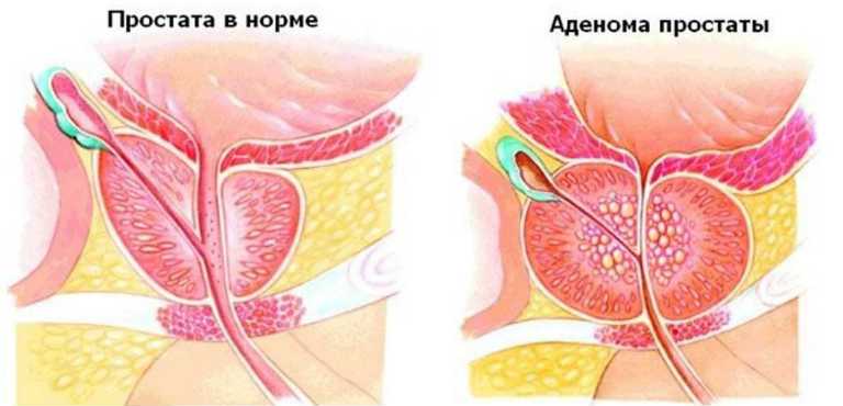 Аденома предстательной железы симптомы и лечение