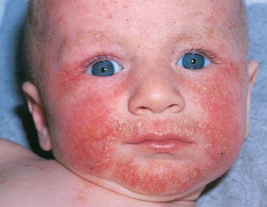 Осложнения при дерматите у детей