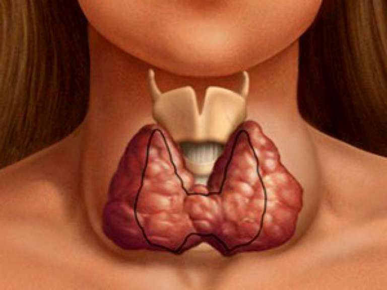 Щитовидная железа, симптомы заболевания у женщин, внешние признаки