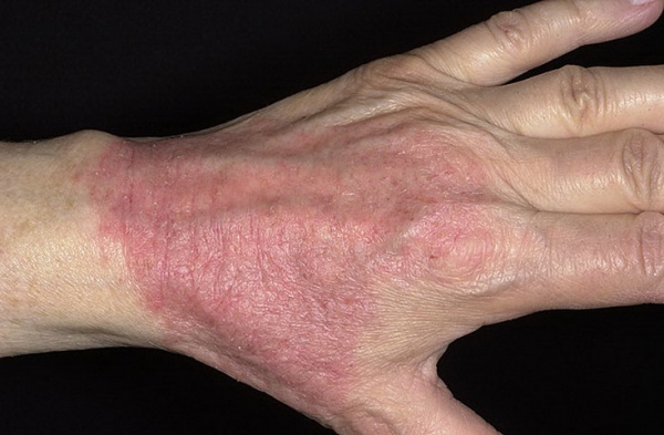 Аллергический дерматит на руках