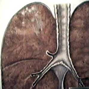 Очаговый туберкулез легких