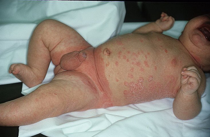 Грибковый дерматит у детей