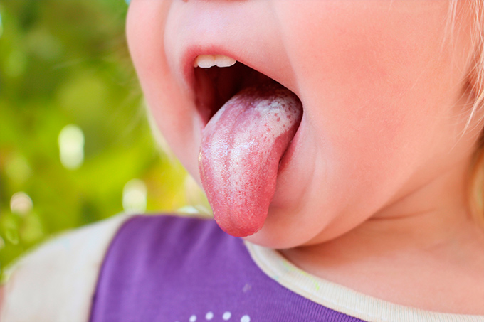 Что значит белый налет на языке у взрослых? Лечение и причины