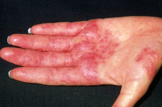 Аллергический дерматит