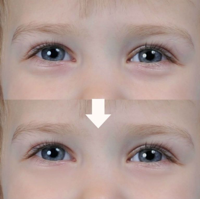 У ребенка темные круги под глазами почему. Припухлость под глазами у ребенка. Мешки под глазами у ребенка.