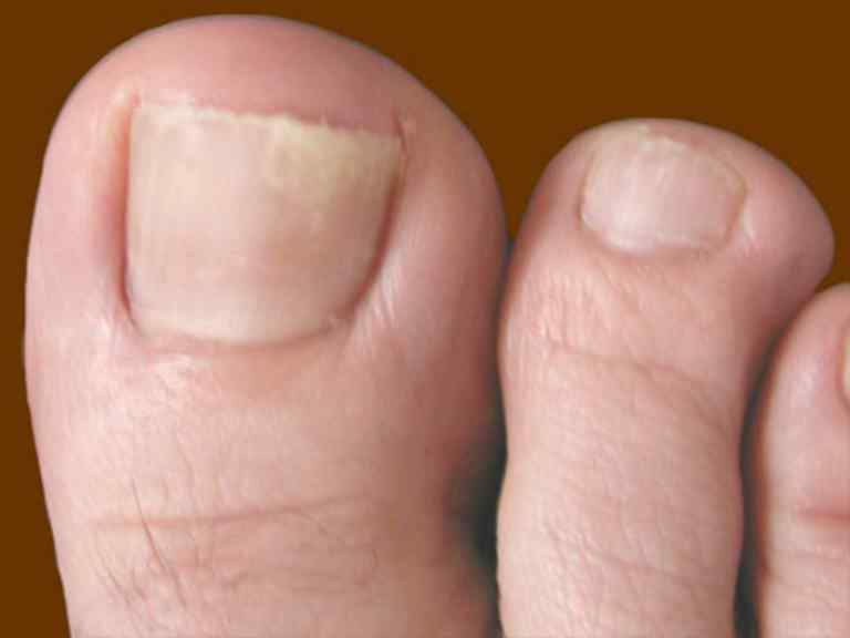 Как избавиться от грибка ногтей на ногах быстро народные средства