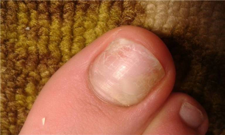 Грибок ногтя на большом пальце ноги, лечение в домашних условиях