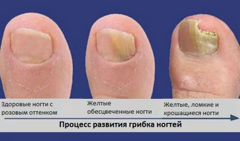 Как избавиться от грибка ногтей на ногах в домашних условиях быстро