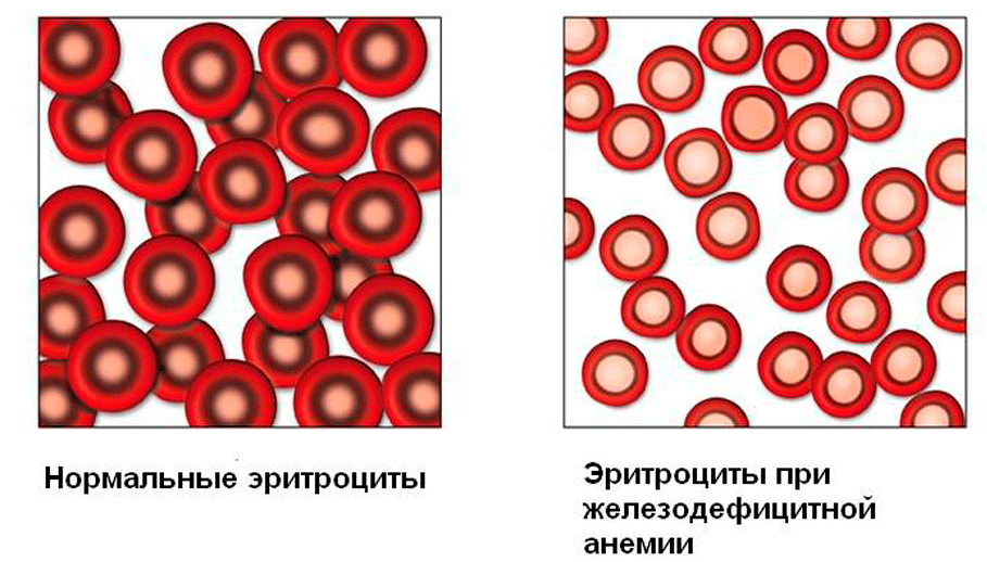 Эритроциты при железодефицитной анемии