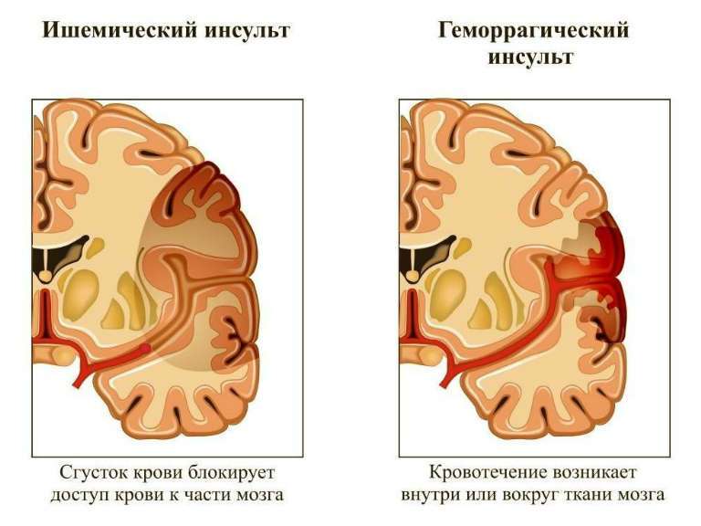 Ишемический инсульт головного мозга лечение