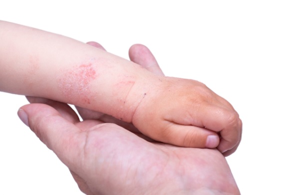 Атопический дерматит на руках у детей