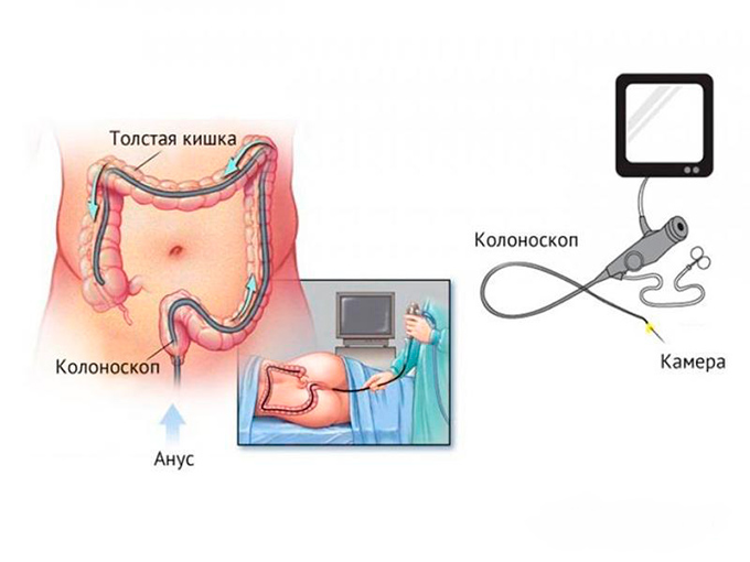 Колоноскопия кишечника: подготовка к процедуре
