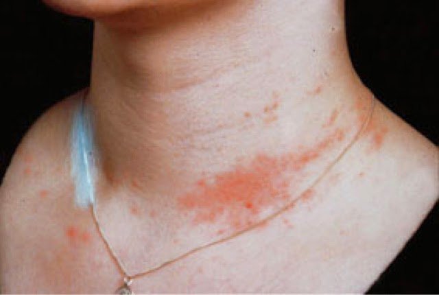 Аллергический дерматит на шее