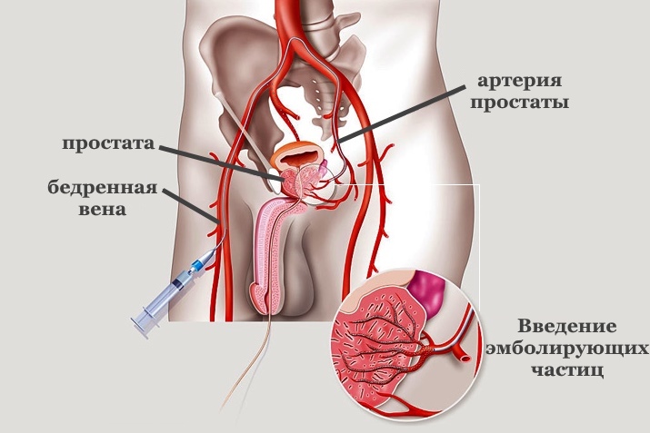 Эмболизация артерий простаты
