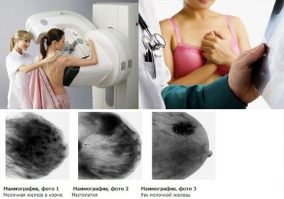 mammografiya