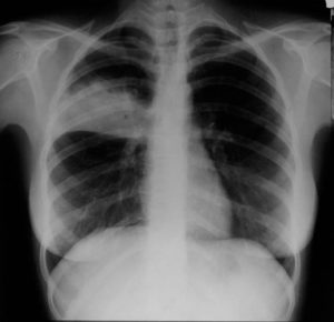 Рентгендиагностика пневмонии