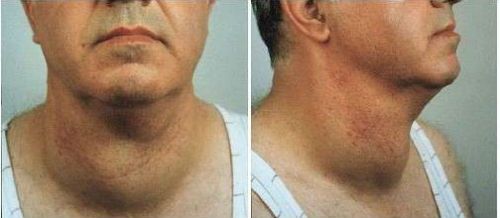 Щитовидная железа симптомы заболевания у мужчин