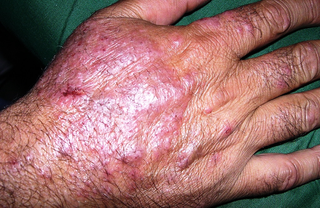 Причины дерматита на руках