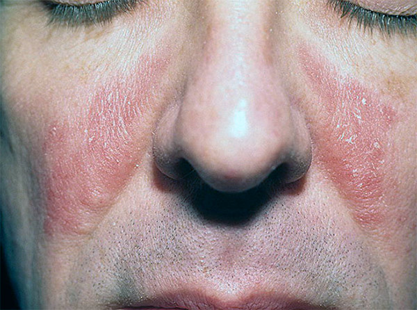 Себорейный дерматит на лице фото симптомы и лечение