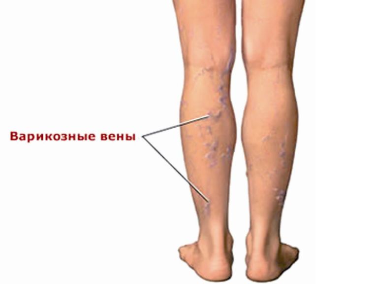 Варикозное расширение вен на ногах, симптомы и лечение | nowfoods-ru