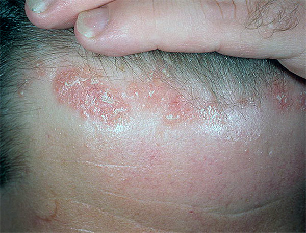 Себорейный дерматит волосистой части головы: одно из самых «не приятных» заболеваний кожи