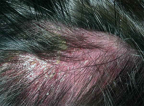 Правильное лечение себорейного дерматита волосистой части головы. Рецепты народной медицины