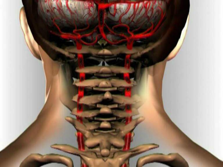 Синдром позвоночной артерии при шейном остеохондрозе, симптомы