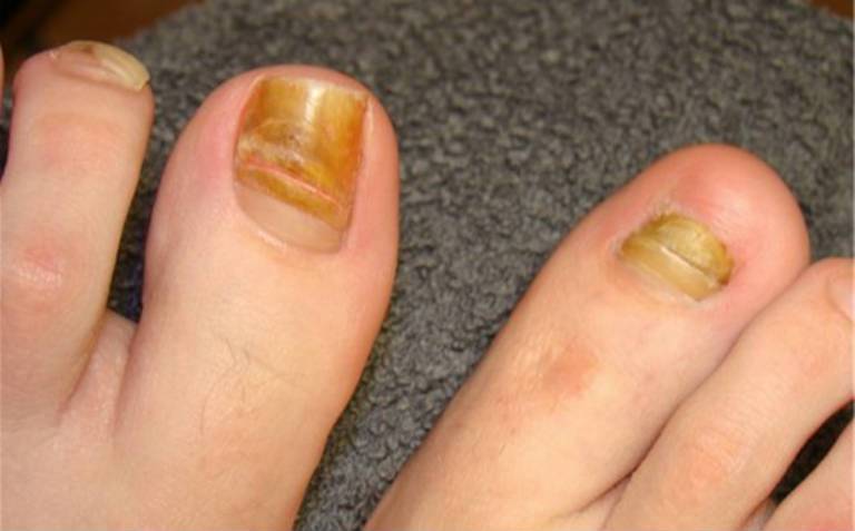 Грибок ногтя на большом пальце ноги, лечение в домашних условиях