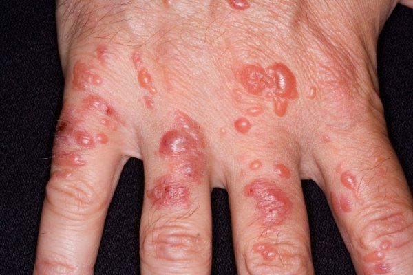 Симптомы дерматита при контакте с аллергеном