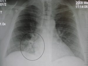 Очаговая пневмония на рентгенограмме