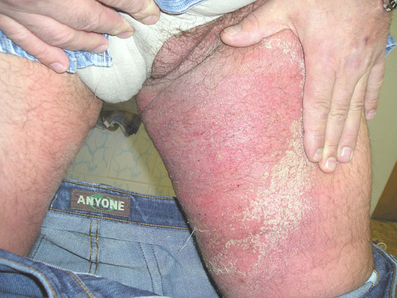Острый атопический дерматит со вторичной инфекцией