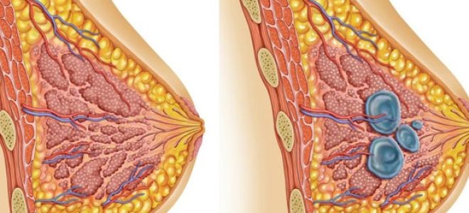 Что такое фиброзно кистозная мастопатия молочной железы