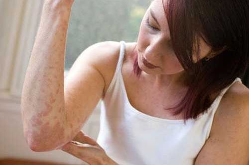 Симптомы и лечение атрофического дерматита