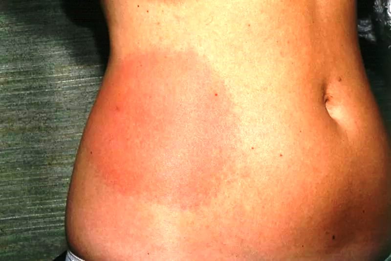 Аллергическая эритема и мазь от дерматита