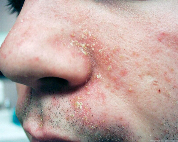Быстрая диагностика и лечение дерматита на лице