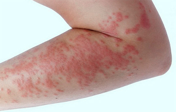 Опоясывающий лишай: спасение кожи и нервной системы от поражения