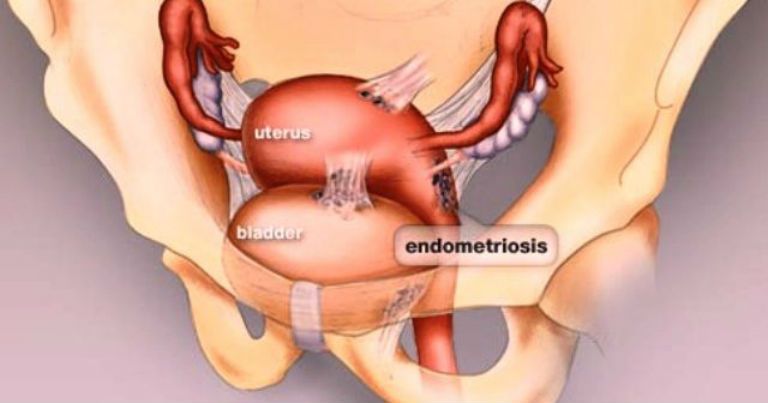 Эндометриоз, симптомы и лечение народными средствами