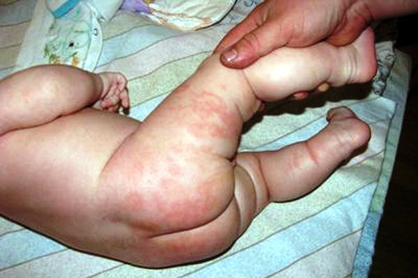 Симптомы пелёночного дерматита