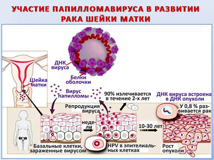 Папилломавирусная инфекция в развитии рака шейки матки