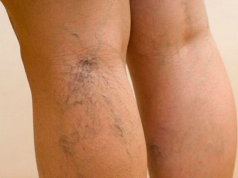 Что такое варикоз вен на ногах, причина возникновения