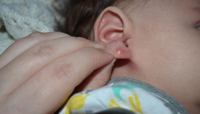 Почему появился шарик в мочке уха? Лучшие советы, как убрать воспаление и шишку внутри