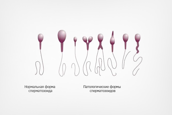 Патологические формы сперматозоидов